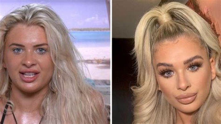 Sydney Love Island Before Surgery